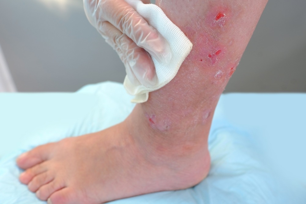 wound healing treatment