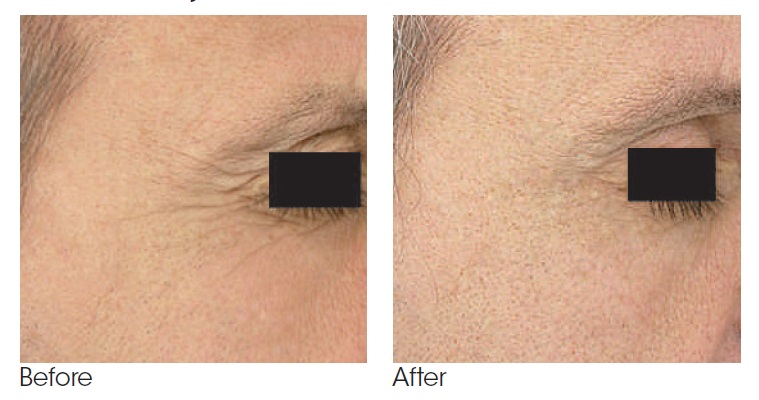 Copy of Aesthetic Blue Laser Photorejuvenation Pre and Post